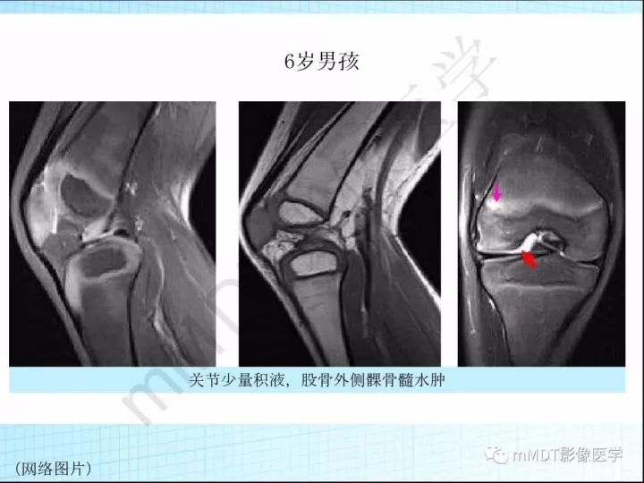 【PPT】骶髂关节非肿瘤病变的影像诊断
