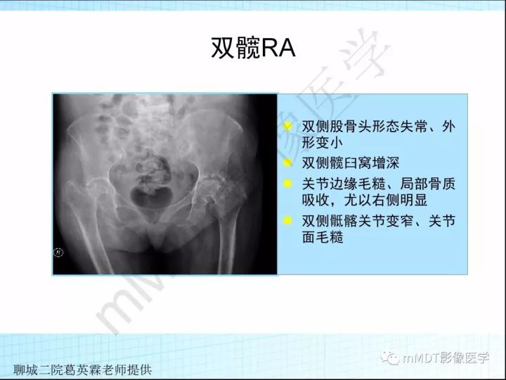 【PPT】骶髂关节非肿瘤病变的影像诊断