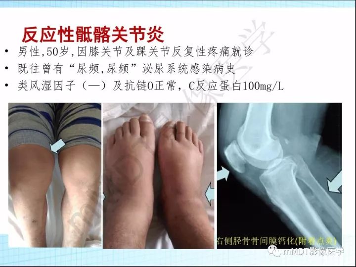 【PPT】骶髂关节非肿瘤病变的影像诊断