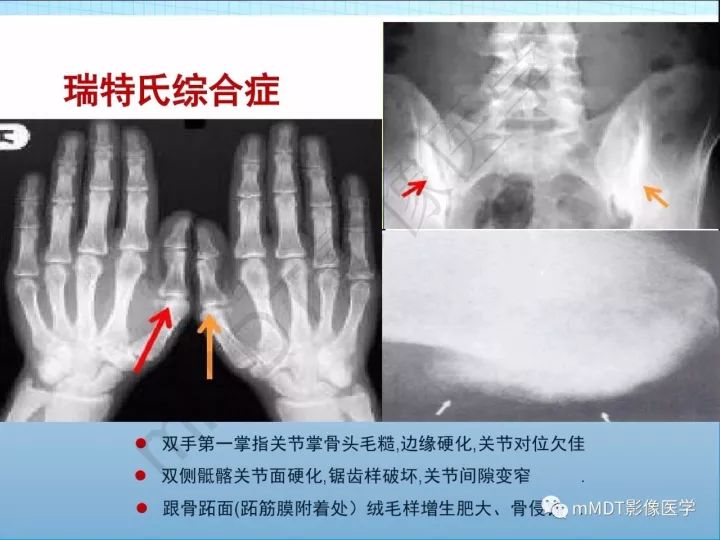 【PPT】骶髂关节非肿瘤病变的影像诊断