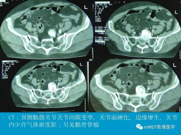 【PPT】骶髂关节非肿瘤病变的影像诊断