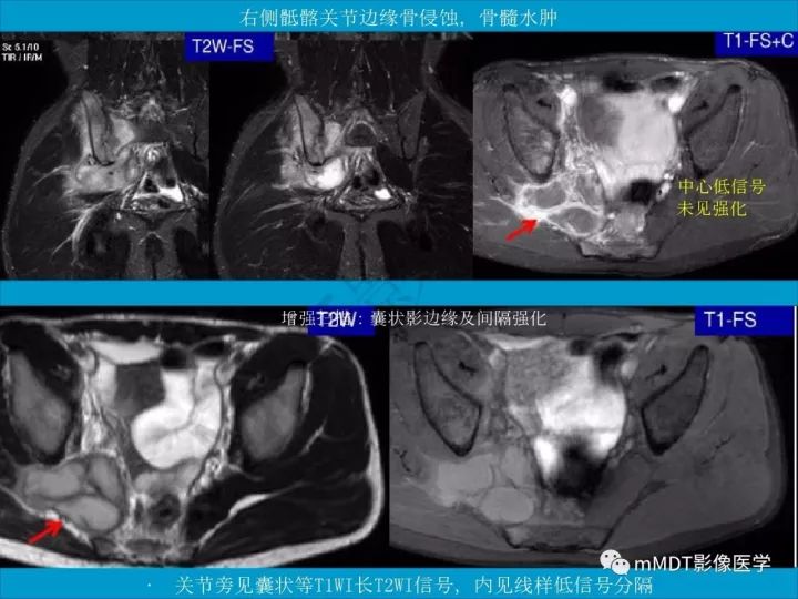 【PPT】骶髂关节非肿瘤病变的影像诊断