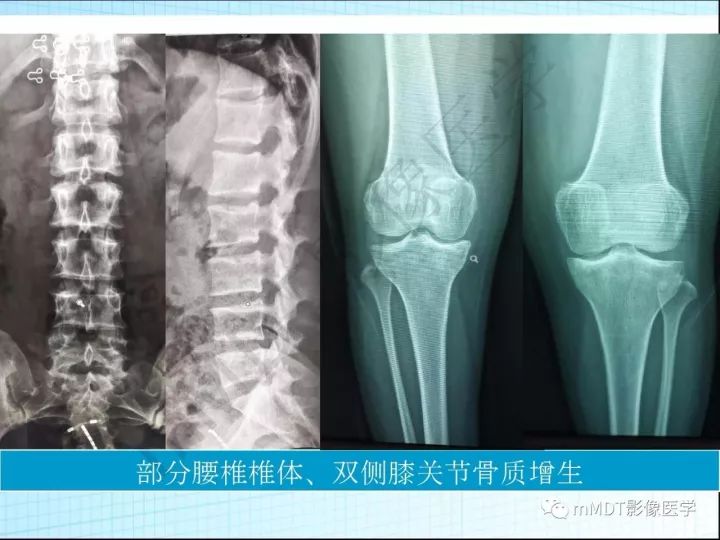 【PPT】骶髂关节非肿瘤病变的影像诊断