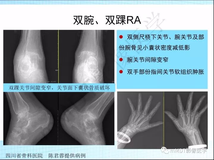 【PPT】骶髂关节非肿瘤病变的影像诊断