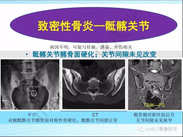 【PPT】骶髂关节非肿瘤病变的影像诊断