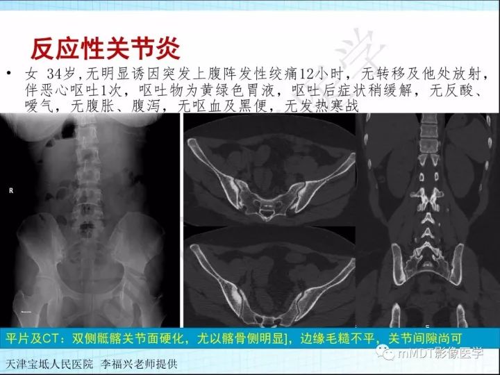 【PPT】骶髂关节非肿瘤病变的影像诊断