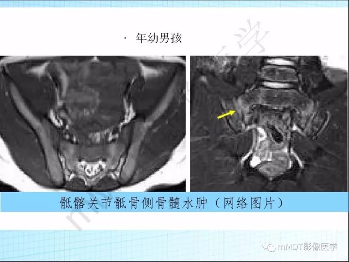 【PPT】骶髂关节非肿瘤病变的影像诊断