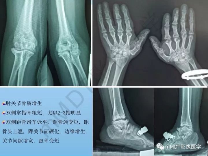 【PPT】骶髂关节非肿瘤病变的影像诊断