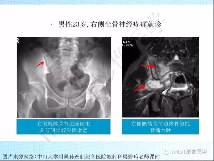 【PPT】骶髂关节非肿瘤病变的影像诊断