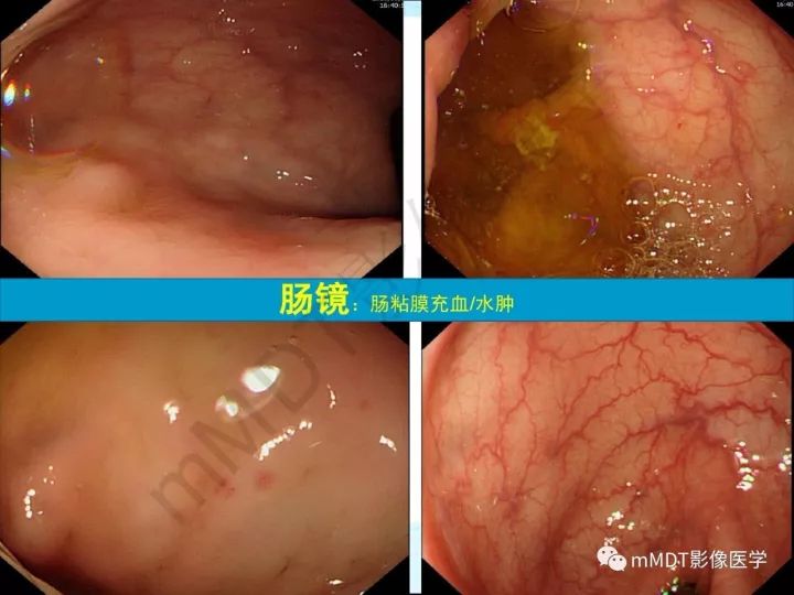 【PPT】骶髂关节非肿瘤病变的影像诊断
