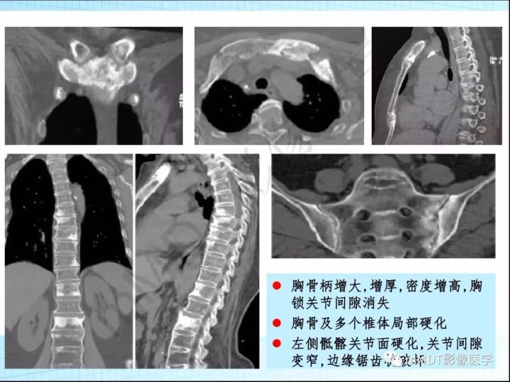 【PPT】骶髂关节非肿瘤病变的影像诊断