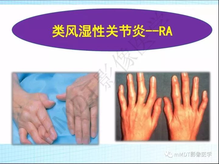 【PPT】骶髂关节非肿瘤病变的影像诊断