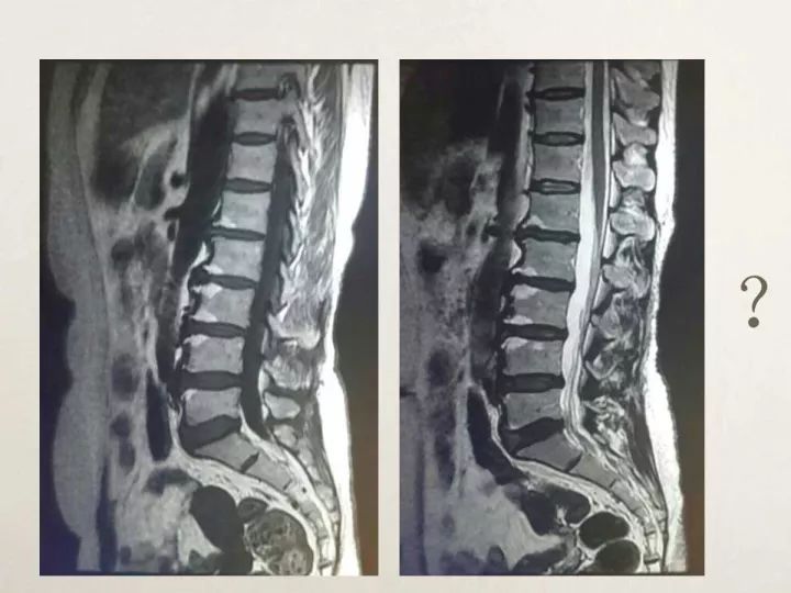 【PPT】终板退变