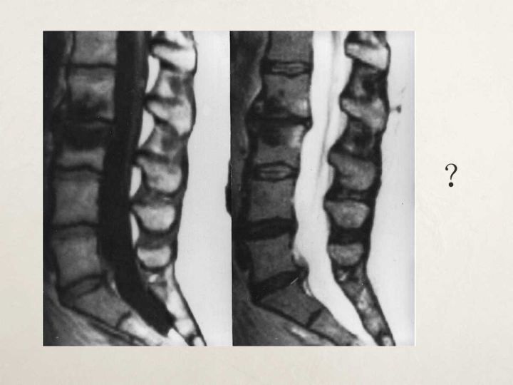 【PPT】终板退变