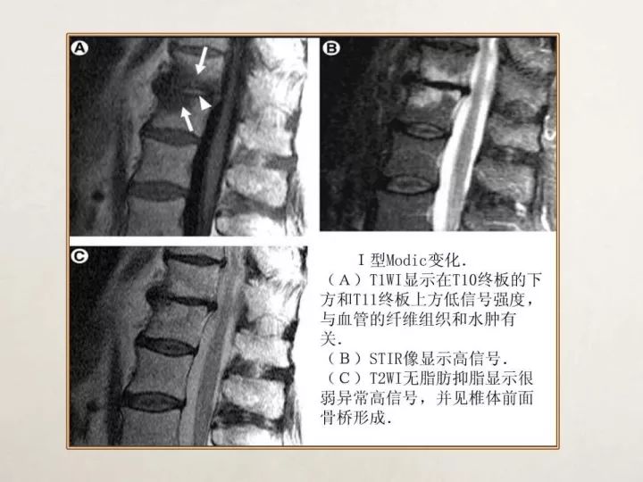 【PPT】终板退变