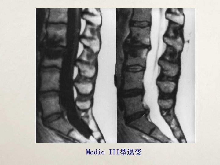 【PPT】终板退变