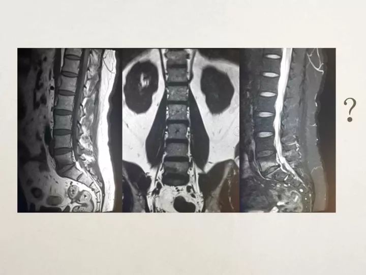 【PPT】终板退变