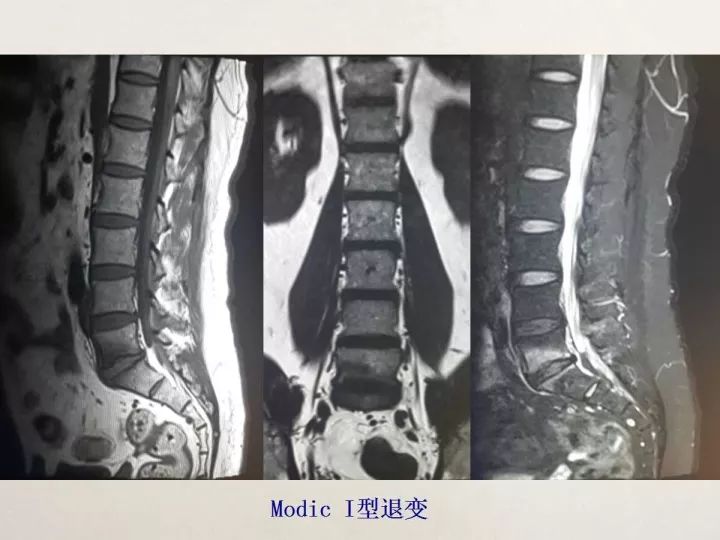 【PPT】终板退变