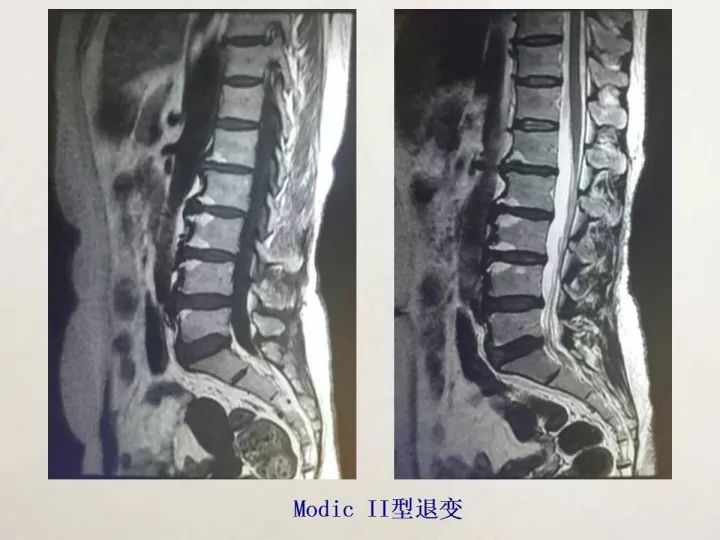 【PPT】终板退变