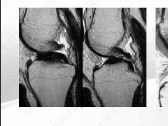 半月板损伤术前及修补术后MR影像学评价