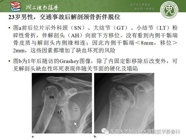 【PPT】急性肩关节损伤：外科医生想获知的内容