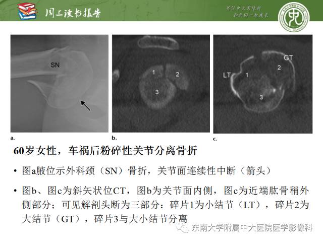 【PPT】急性肩关节损伤：外科医生想获知的内容