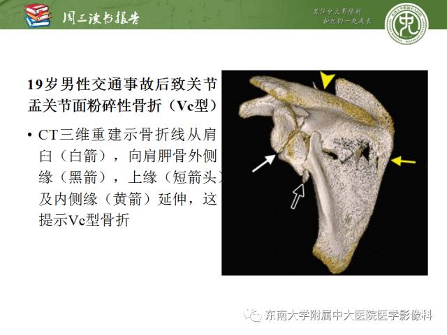 【PPT】急性肩关节损伤：外科医生想获知的内容