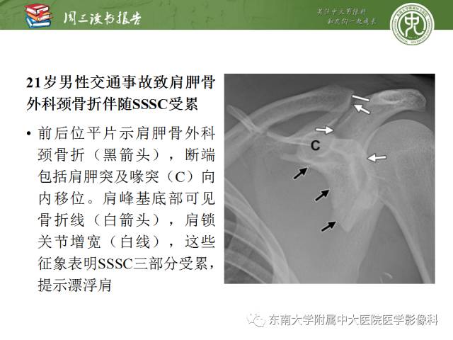 【PPT】急性肩关节损伤：外科医生想获知的内容
