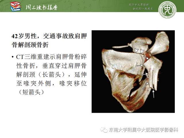 【PPT】急性肩关节损伤：外科医生想获知的内容