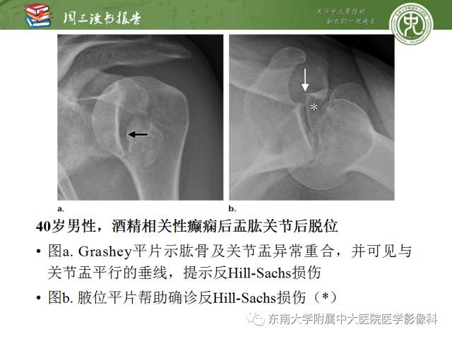 【PPT】急性肩关节损伤：外科医生想获知的内容