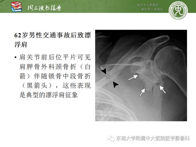 【PPT】急性肩关节损伤：外科医生想获知的内容