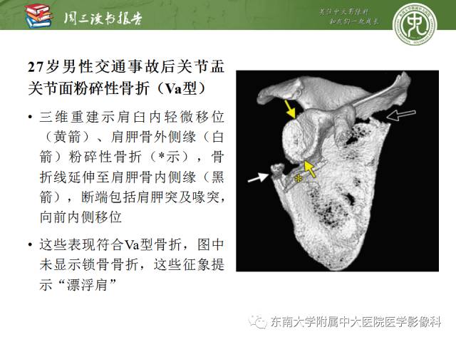 【PPT】急性肩关节损伤：外科医生想获知的内容
