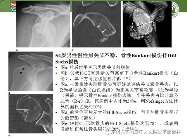 【PPT】急性肩关节损伤：外科医生想获知的内容