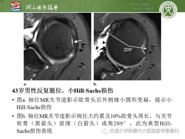 【PPT】急性肩关节损伤：外科医生想获知的内容