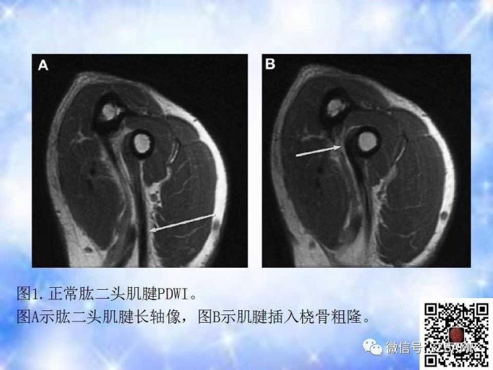 【PPT】肘关节磁共振正常解剖及假性病变