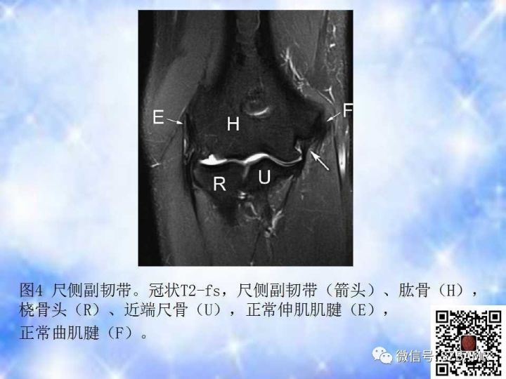 【PPT】肘关节磁共振正常解剖及假性病变