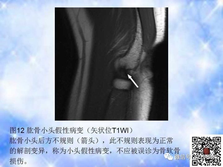 【PPT】肘关节磁共振正常解剖及假性病变