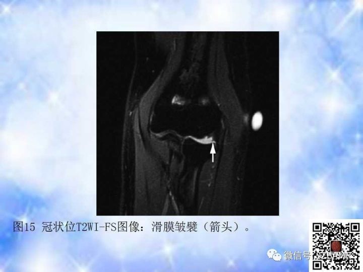 【PPT】肘关节磁共振正常解剖及假性病变