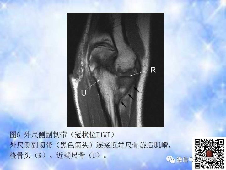 【PPT】肘关节磁共振正常解剖及假性病变