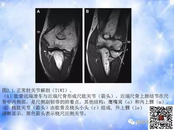 【PPT】肘关节磁共振正常解剖及假性病变
