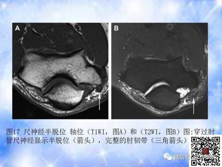 【PPT】肘关节磁共振正常解剖及假性病变