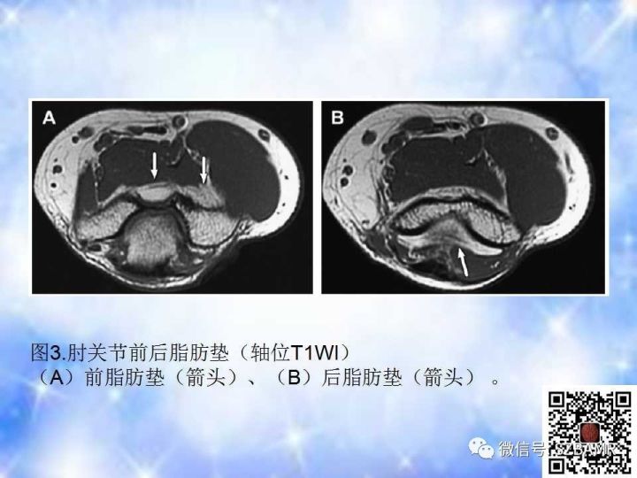 【PPT】肘关节磁共振正常解剖及假性病变