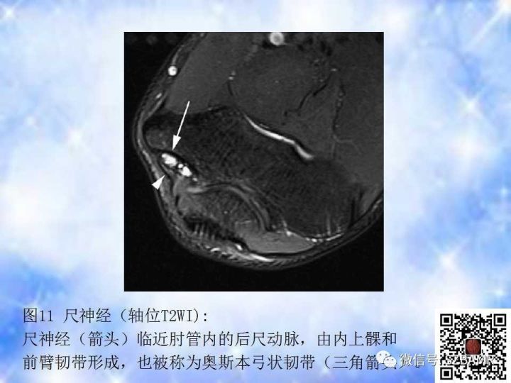 【PPT】肘关节磁共振正常解剖及假性病变