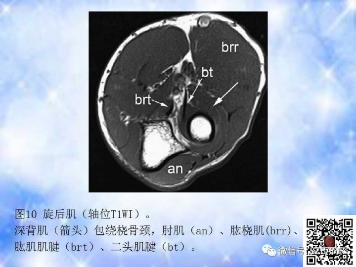 【PPT】肘关节磁共振正常解剖及假性病变