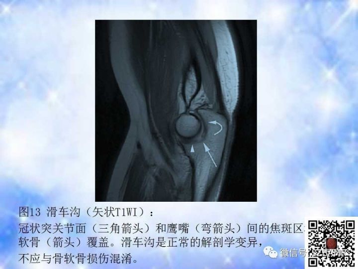 【PPT】肘关节磁共振正常解剖及假性病变