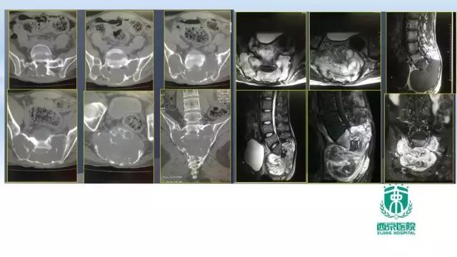 【PPT】常见椎体单发溶骨性病变