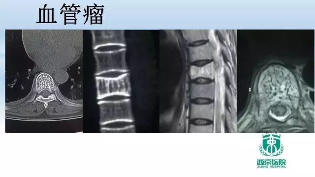 【PPT】常见椎体单发溶骨性病变