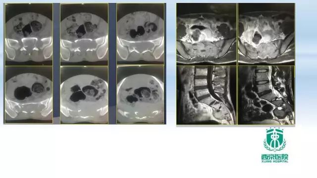 【PPT】常见椎体单发溶骨性病变