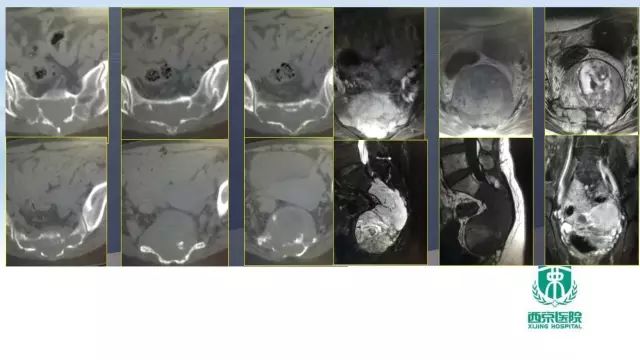 【PPT】常见椎体单发溶骨性病变