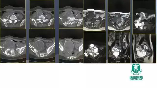 【PPT】常见椎体单发溶骨性病变